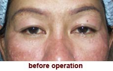 plastic-surgery-blepharoplasty